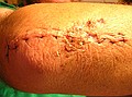 surgical incision, ~4" long, with 11 stiches