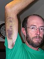 bruise from internal bleeding after surgery