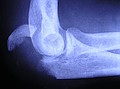fractured right olecranon (tip of the ulna, the boniest part of elbow to which the tricep attaches)